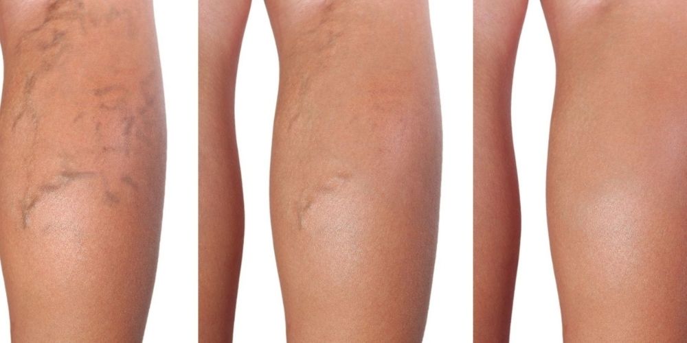 How Will Laser Therapy Treat My Complaints?