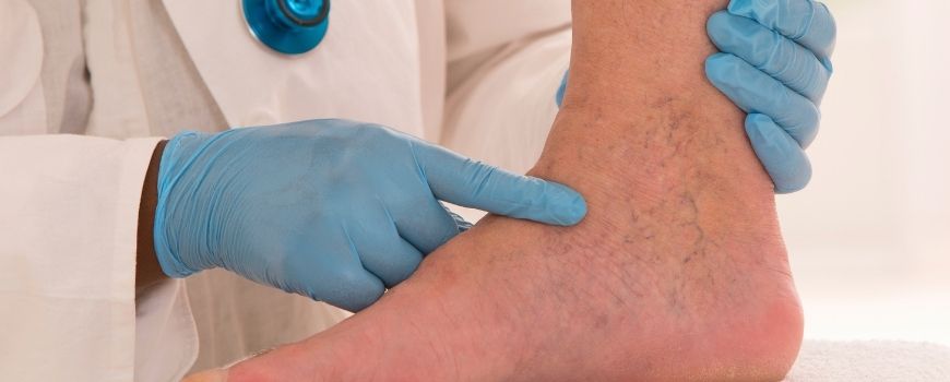 Varis ve ödem ilişkisi